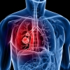 영양분 부족해도 살아남는 폐암세포 비밀 밝혀냈다