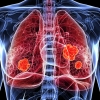 암 사망률 1위 폐암 피검사로 조기진단하고 5년 생존률까지 예측한다