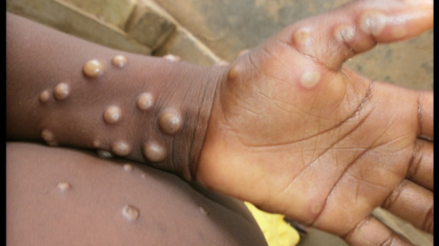 원숭이 두창 환자의 피부 증상 나이지리아 질병통제센터 세계보건기구