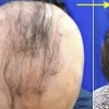 “탈모 환자 머리카락 80% 다시 자랐다”…美서 신약 개발