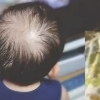 “3살 아들 머리카락 다 빠졌다” 코로나 후유증 심각