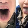 “검게 변한 혀·벗겨진 피부”…코로나 이상 증세에 변이 공포 확산