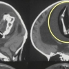 1세 아기 두개골에…또 다른 ‘쌍둥이’ 자라고 있었다