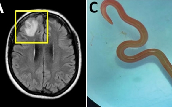 호주 건망증 여성 뇌 속에 8㎝ 벌레 살아서 ‘꿈틀’…“최초 사례”