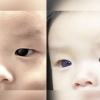 “생후 6개월 된 아기, 코로나 치료 후 눈 색깔 변했다”