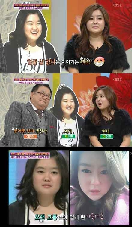 이용식의 딸 이수민(위)이 성형 후 달라진 얼굴을 자랑하고 있다. /KBS2
 ‘여유만만’ 방송 캡처