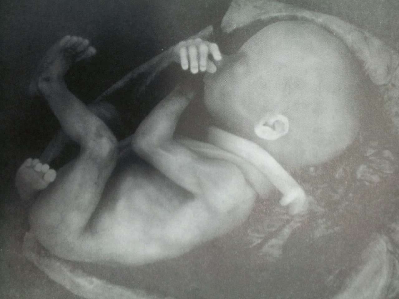 태아가 탯줄로 목을 감고 자살한 사진. 미국 뉴올리안즈 산부인과 콜린스 박사 제공
