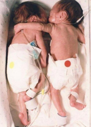 1995년 죽어 가는 쌍둥이 동생 브리엘을 언니가 포옹으로 살렸다.