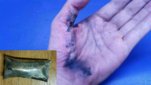 지난 17일 배터리 폭발사고로 화상을 입은 송모씨의 왼손. 배터리 폭발사고로 부풀어 오른 삼성전자 갤럭시S5의 정품 배터리(작은 사진).