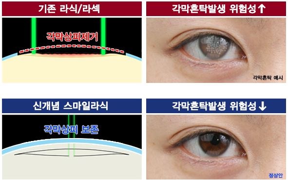 라식·라섹 수술 후 뿌옇게 변질된 각막, 각막혼탁 부작용 주의 | 서울신문