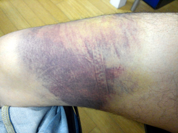 2년간의 폭행, 허벅지에 시퍼런 ’멍’