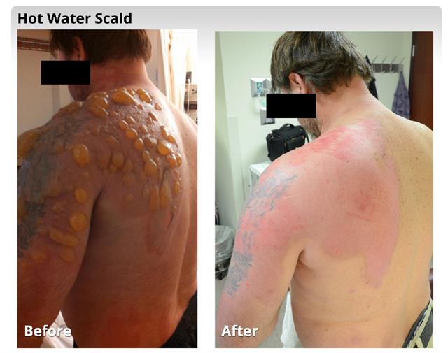 뜨거운 물에 왼쪽 어깨부터 팔꿈치까지 심한 화상을 입은 43세 남성 환자의 치료 전후 모습.