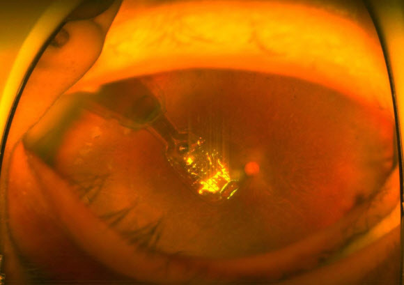 국내 최초로 환자의 망막에 이식된 백금칩. 서울아산병원 제공