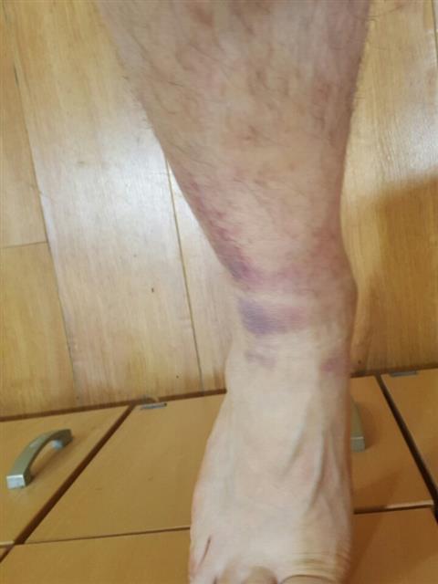전북대병원 폭행 피해자인 A씨의 멍든 다리. 종아리와 발목 부위에 출혈로 검붉게 물든 부분이 보인다. A씨 제공