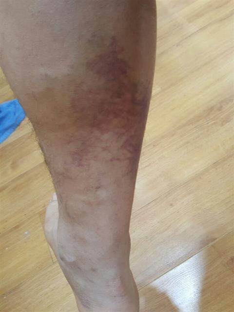 전북대병원 폭행 피해자인 A씨의 멍든 다리. 종아리와 발목 부위에 출혈로 검붉게 물든 부분이 보인다. A씨 제공