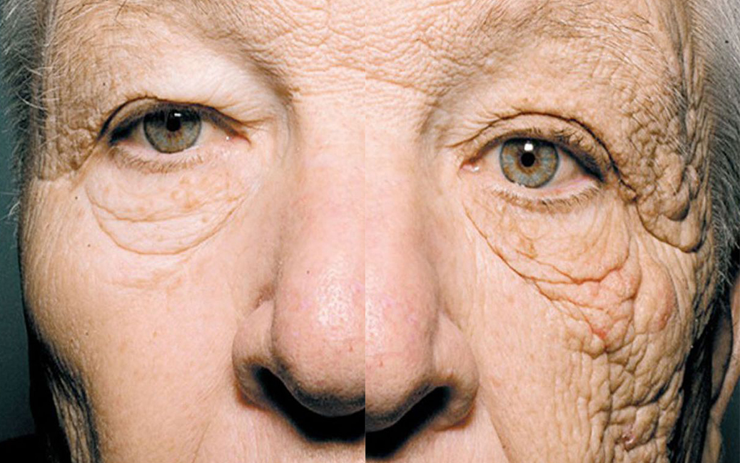 28년간 자외선에 노출되 심하게 손상된 트럭운전사의 왼쪽 얼굴모습(사진출처:New-England-Journal-of-Medicine)