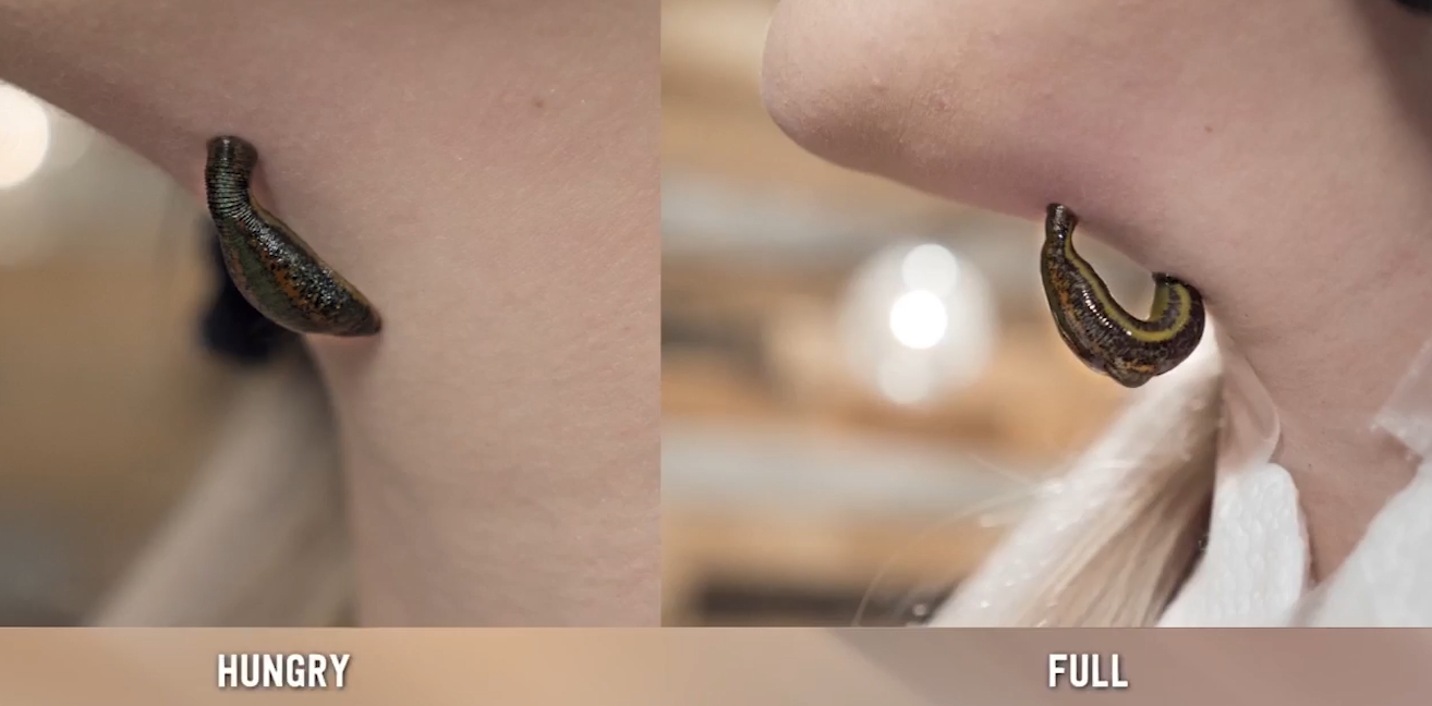 거머리를 이용한 미용 케어를 받기 전과 후의 거머리 상태변화 모습(유튜브 영상 캡처)