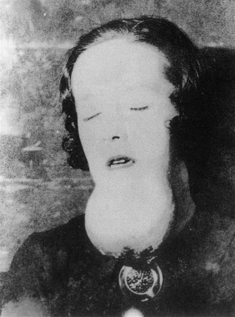 라듐에 피폭된 한 여성의 턱에 커다란 육종이 생긴 모습. 사일런스북 제공