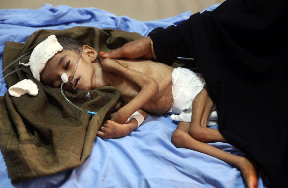 7일(현지시간) 영양 실조에 걸린 예멘의 한 아이가 예멘 호데이다의 한 병원에서 치료를 기다리고 있다. 사우디의 지원을 받는 수니파 정부와 이란의 지원을 받는 후티족 시아파 반군 사이의 전쟁은 아랍의 가장 가난한 나라인 예멘을 기근의 직전까지 몰고 가고 있다. AFP 연합뉴스