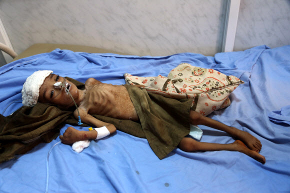 7일(현지시간) 영양 실조에 걸린 예멘의 한 아이가 예멘 호데이다의 한 병원에서 치료를 기다리고 있다. 사우디의 지원을 받는 수니파 정부와 이란의 지원을 받는 후티족 시아파 반군 사이의 전쟁은 아랍의 가장 가난한 나라인 예멘을 기근의 직전까지 몰고 가고 있다. AFP 연합뉴스