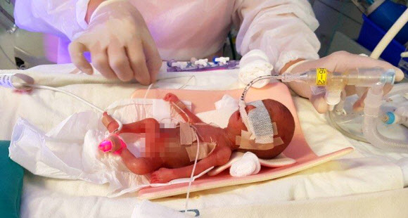 체중 302g, 키 21.5㎝로 태어난 이사랑 아기가 지난 1월 26일 서울아산병원 신생아중환자실 인큐베이터에서 기관지에 폐표면활성제를 투여하는 치료를 받고 있다.  서울아산병원 제공
