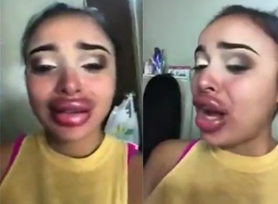 남보다 두툼한 입술을 갖고 싶었던 한 젊은 여성이 잘못된 성형수술의 부작용으로 된 모습(유튜브 영상 캡처)