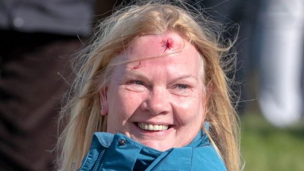 4일(이하 현지시간) 스코틀랜드 킹스반스 골프 클럽에서 열린 알프레드 던힐 링크스 챔피언십 첫날 타이렐 해튼이 15번홀에서 날린 샷이 불규칙 바운드돼 이마를 찢기는 부상을 당한 여성 갤러리. PA통신