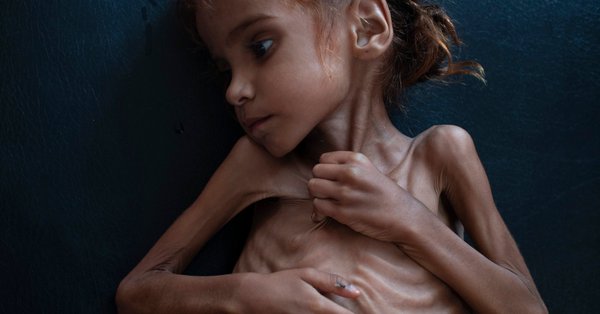 영양실조로 숨진 예멘 7세 소녀 아말 후세인의 생전 모습.=마이클 슬랙먼 뉴욕타임스 국제에디터 트위터 캡처
