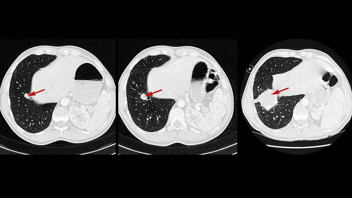 폐암환자의 암세포(화살표) 조직이 항암면역치료를 받은 뒤 7주 동안(가운데, 오른쪽) 급격히 커지고 있는 모습 사이언스 제공