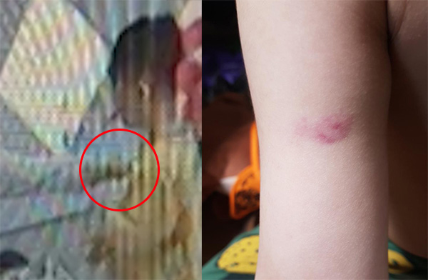 4월 22일 인천 남동구 논현동의 한 어린이집 보육교사가 식판을 반납하던 6살 아이의 팔을 꼬집고 있다(사진왼쪽). 아이 팔에 생긴 피멍.