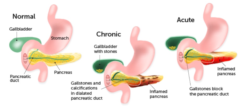 정상췌장, 만성췌장염, 급성췌장염 비교