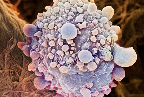 췌장암 세포의 전자현미경 모습