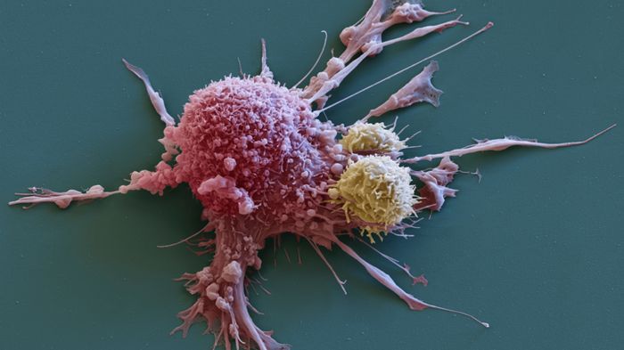 암세포의 전자현미경 모습