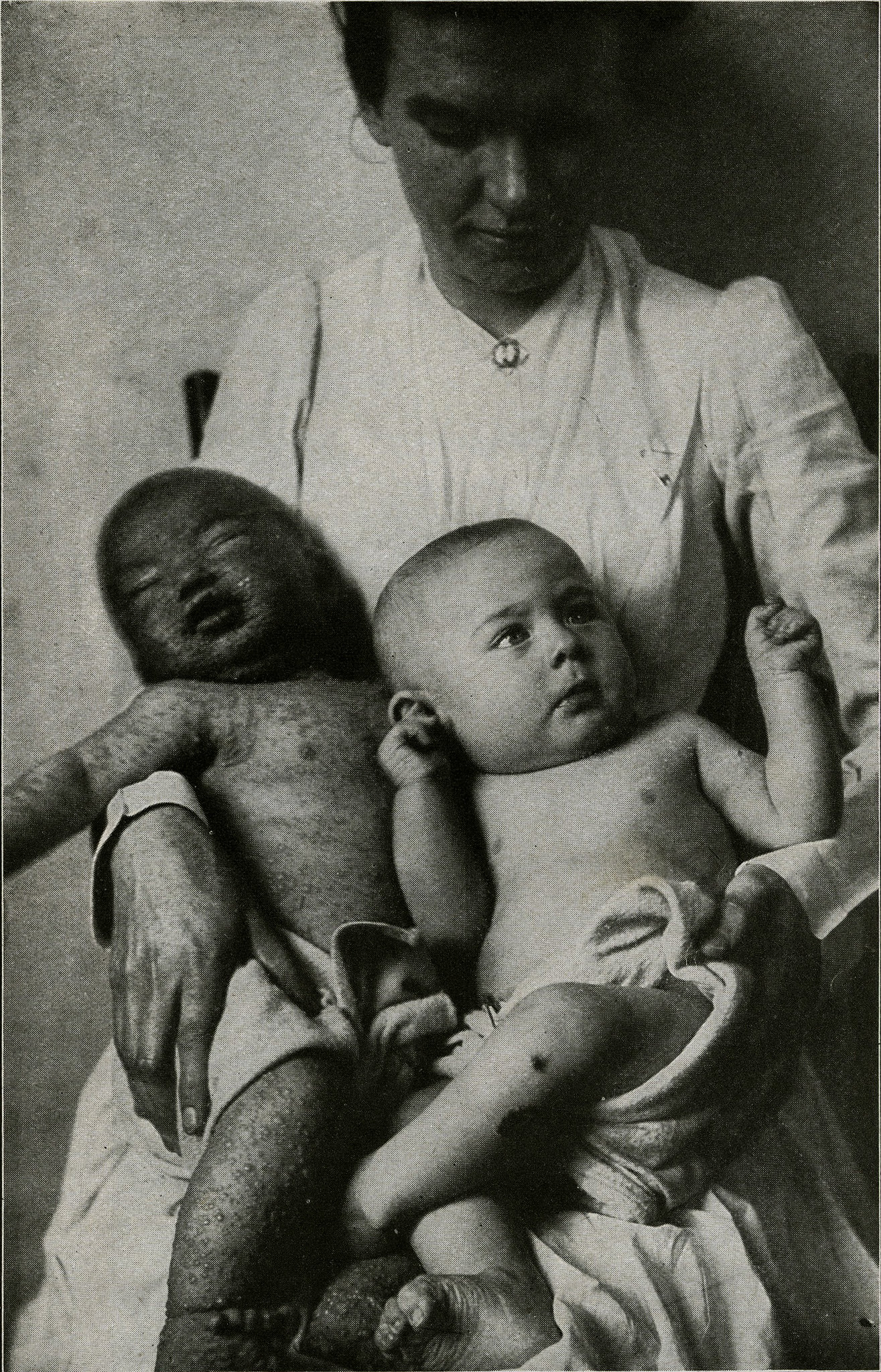 천연두 예방접종을 하지 않은 아기(왼쪽)와 예방접종을 한 아기. 미국 국립보건의료박물관 홈페이지