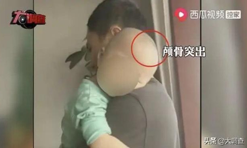 머리가 커지는 부작용을 낳는 불량 분유를 보도한 중국 방송 화면 캡처