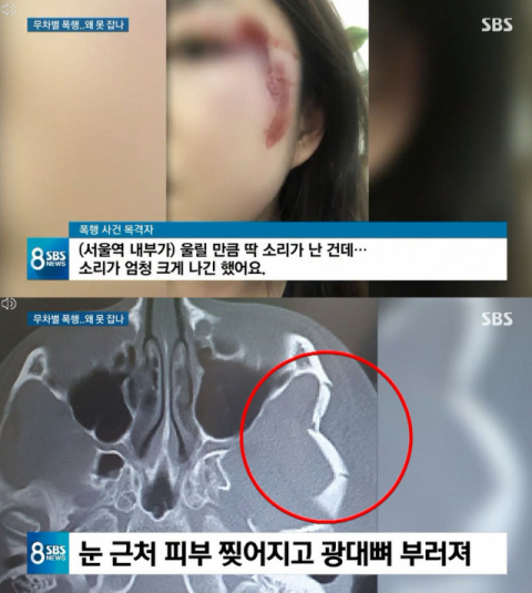 서울역 묻지마 폭행 피해자.<br>SBS 보도 캡처.