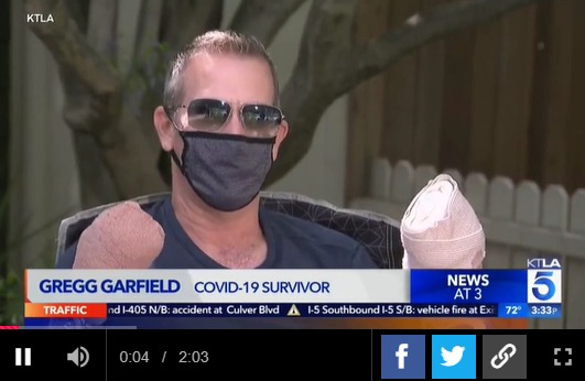 코로나19 합병증으로 손가락을 모두 잃은 미국 남성 그레그 가필드/영상 캡처