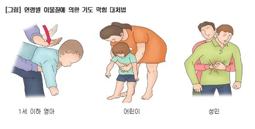 생명 구하는 하임리히법/서울아산병원 제공