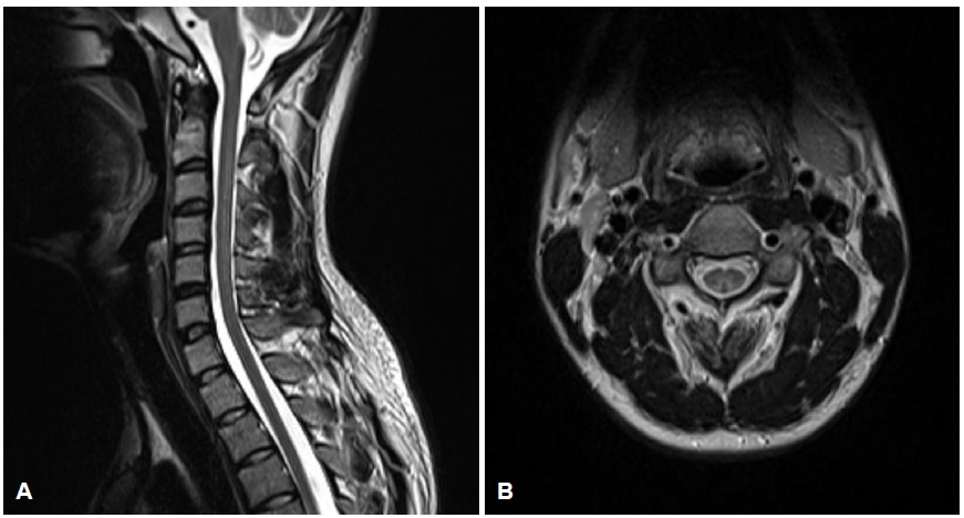 해피벌룬을 남용하다가 척수신경병에 걸린 20대 남성의 척수 MRI 영상. 대한신경과학회지