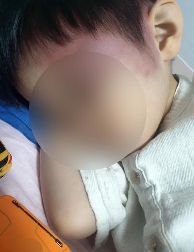 피해 아동 친부가 공개한 피해 아동 얼굴. 시퍼런 피멍이 들어 있다.  연합뉴스  