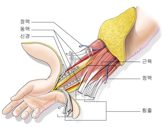 수부 이식 일러스트. 세브란스병원 및 장동수(studioMID 제공)