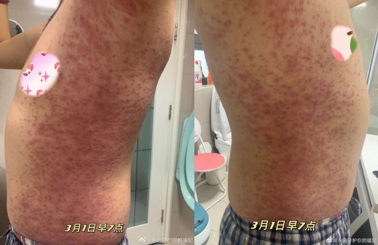 “시노팜 백신 맞은뒤 온몸에 붉은 반점” 백신 접종자의 온몸에 퍼진 붉은 반점 사진. 웨이보 캡처