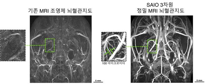 새로운 조영제 ‘사이오’ 이용한 뇌혈관 촬영 사진