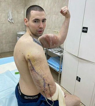 신톨 제거 수술을 받은 러시아 청년 테레신. 인스타그램