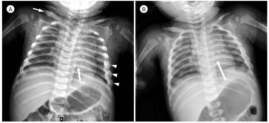 학대받은 생후 3개월 아동의 엑스레이 사진. 늑골이 부러진 부위가 보인다. 대한영상의학회지
