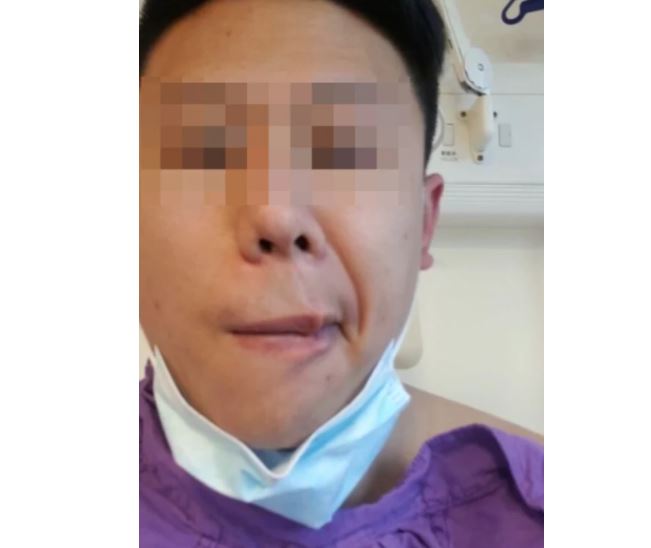 시노백 백신 맞고 안면 신경이 마비된 홍콩 남성 윌슨 람. 사진=SCMP 홈페이지 캡처