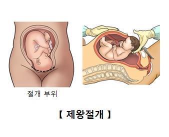 제왕절개 분만 개략도. 서울아산병원 제공