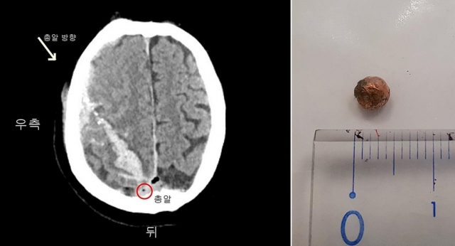 환자의 뇌 CT 사진과 몽에서 빼낸 총알. 의정부성모병원 제공