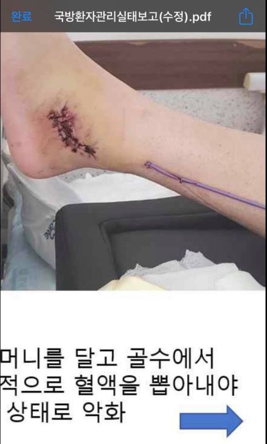 발목을 다친 피해 군인의 상태. 페이스북 ‘육군훈련소 대신 전해드립니다’캡처