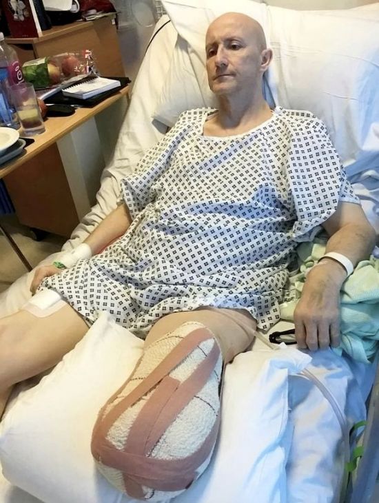 전직 무술 세계 챔피언 데이브 미어스(58)가 지난 3월 아스트라제네카(AZ) 백신을 접종한 이후 알 수 없는 세균 감염으로 오른쪽 다리가 심하게 부풀어 올라 결국 다리를 절단했다. 페이스북 캡처